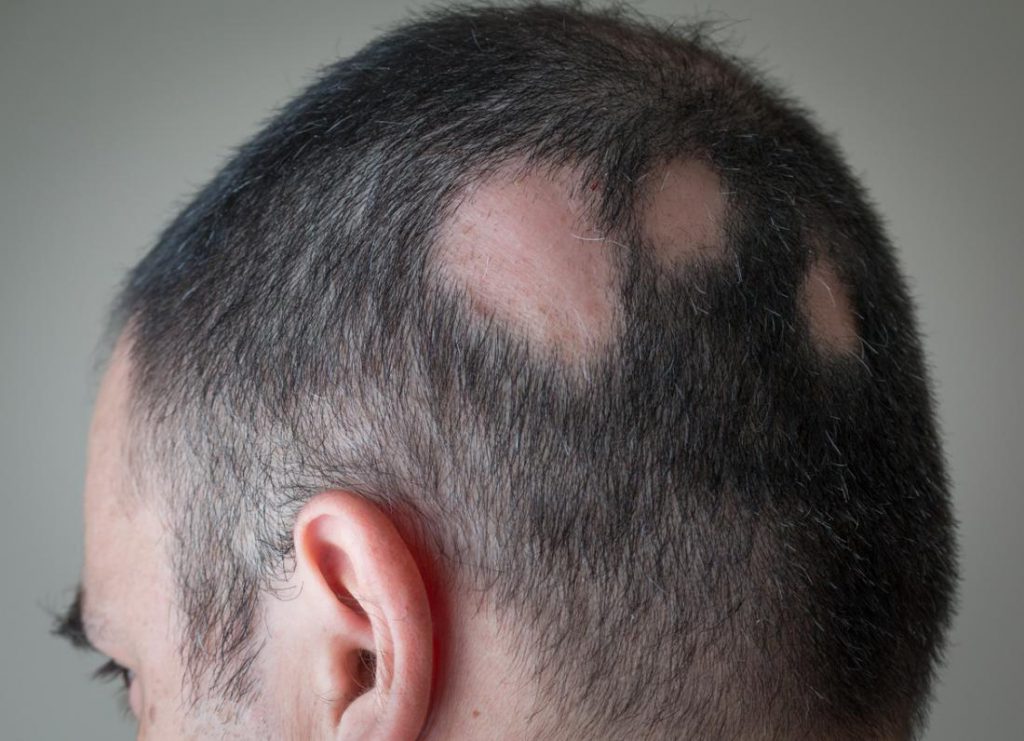 ریزش موی سکه ای یا آلوپسی و روش های درمان